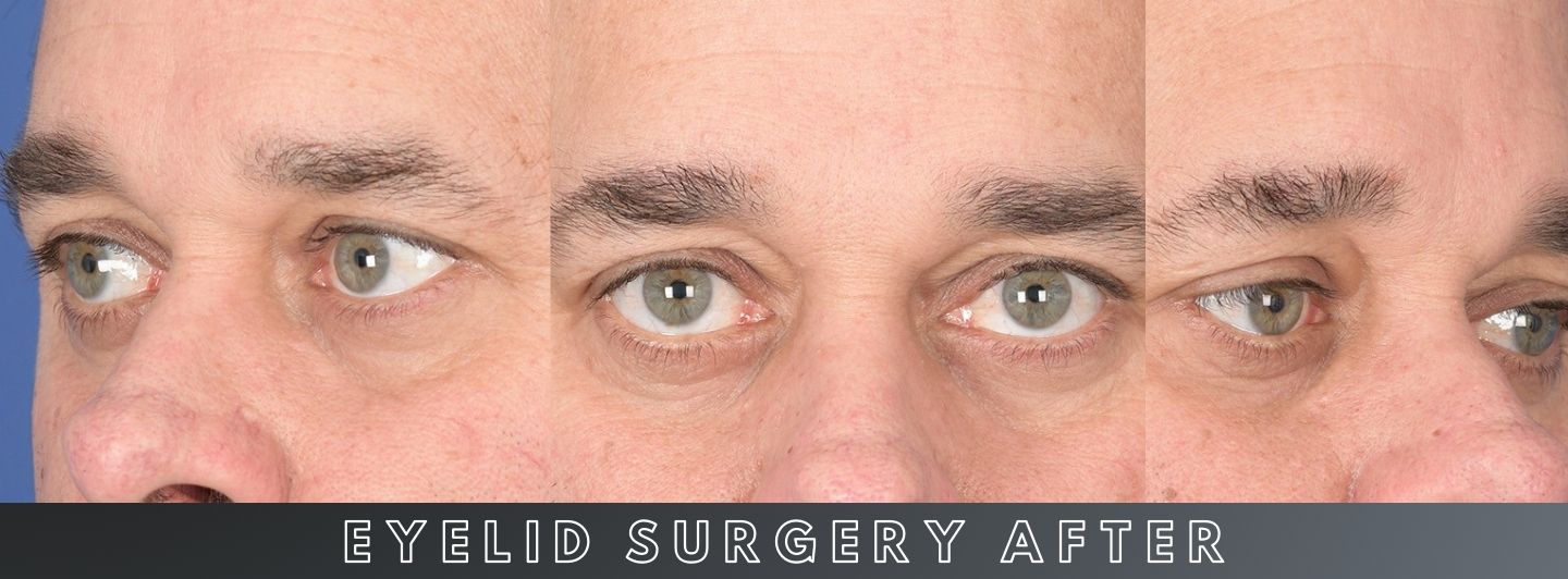 C1 Eyelid Surgery AFTER