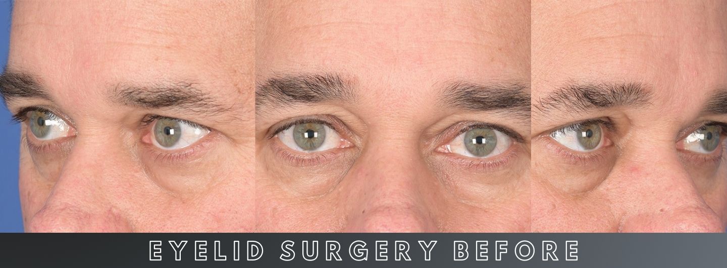 C1 Eyelid Surgery BEFORE