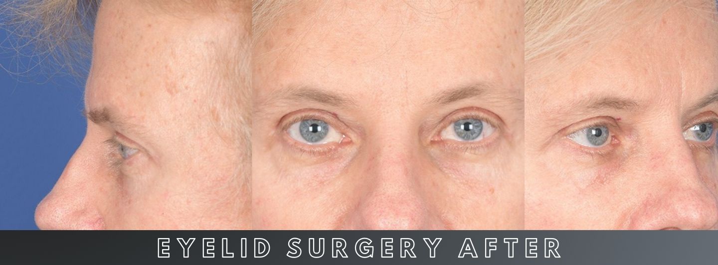 C2 Eyelid Surgery AFTER