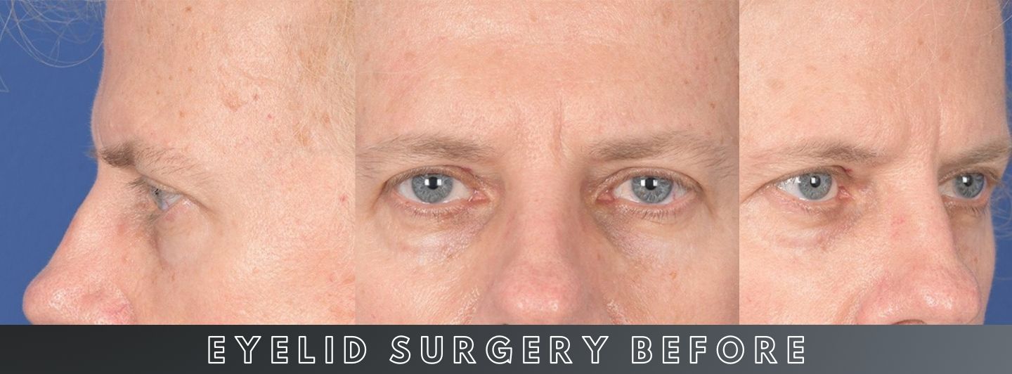 C2 Eyelid Surgery BEFORE