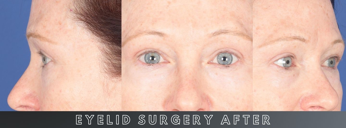 C3 Eyelid Surgery AFTER