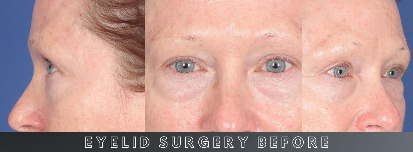 C3 Eyelid Surgery BEFORE