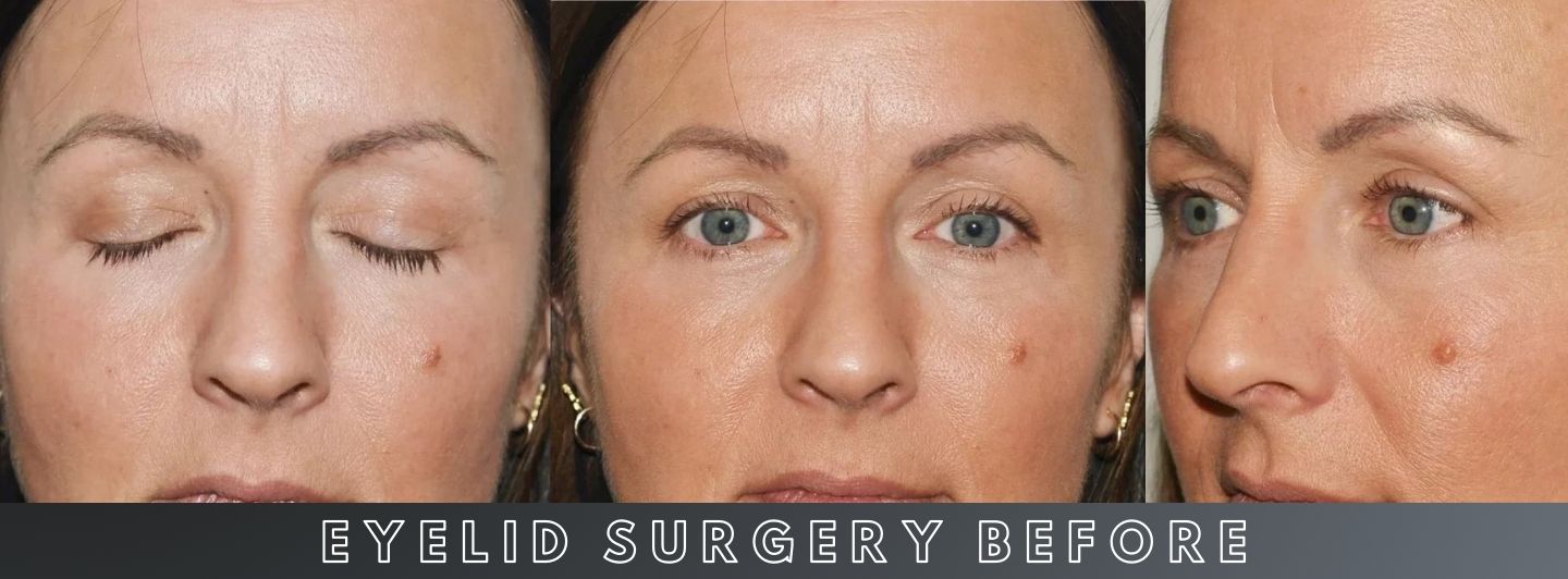 C4 Eyelid Surgery BEFORE