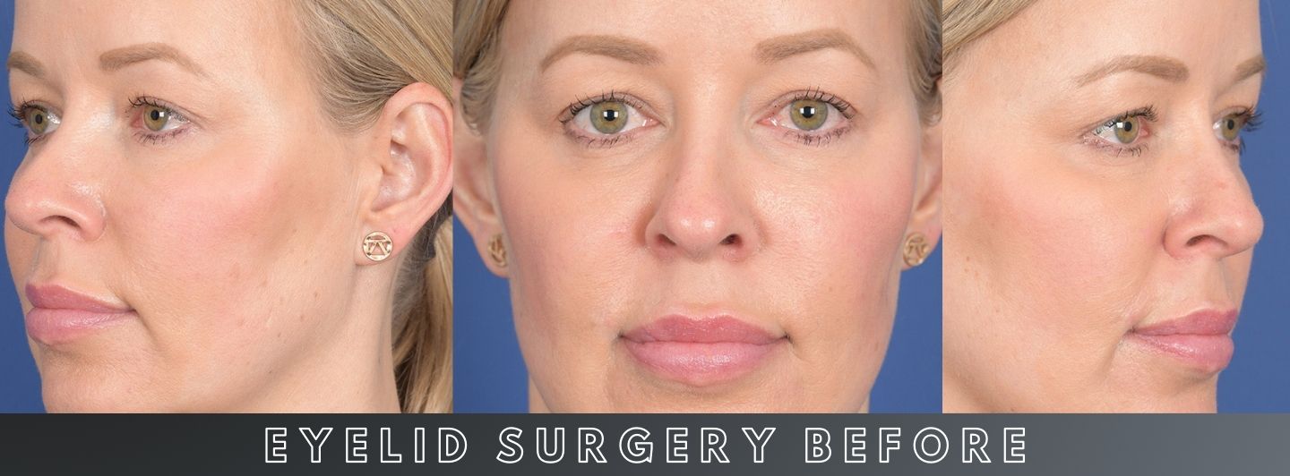 C5 Eyelid Surgery BEFORE
