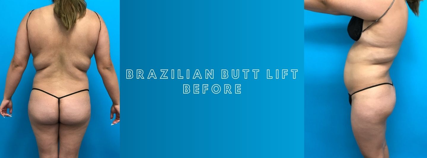 Case1 BRAZILIAN BUTT LIFT before