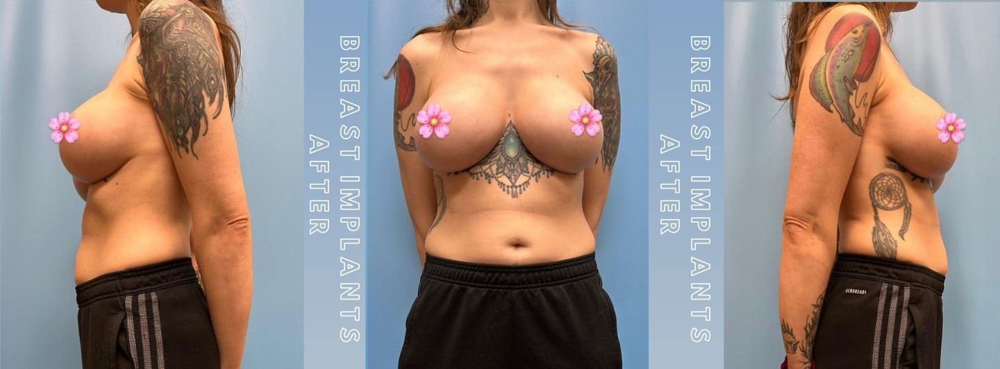 Case1 BREAST IMPLANTS AFTER