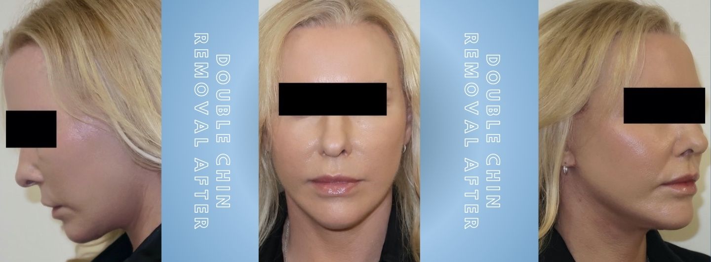 Case1 Double Chin Removal after