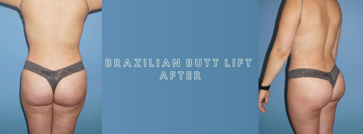 Case2 BRAZILIAN BUTT LIFT after