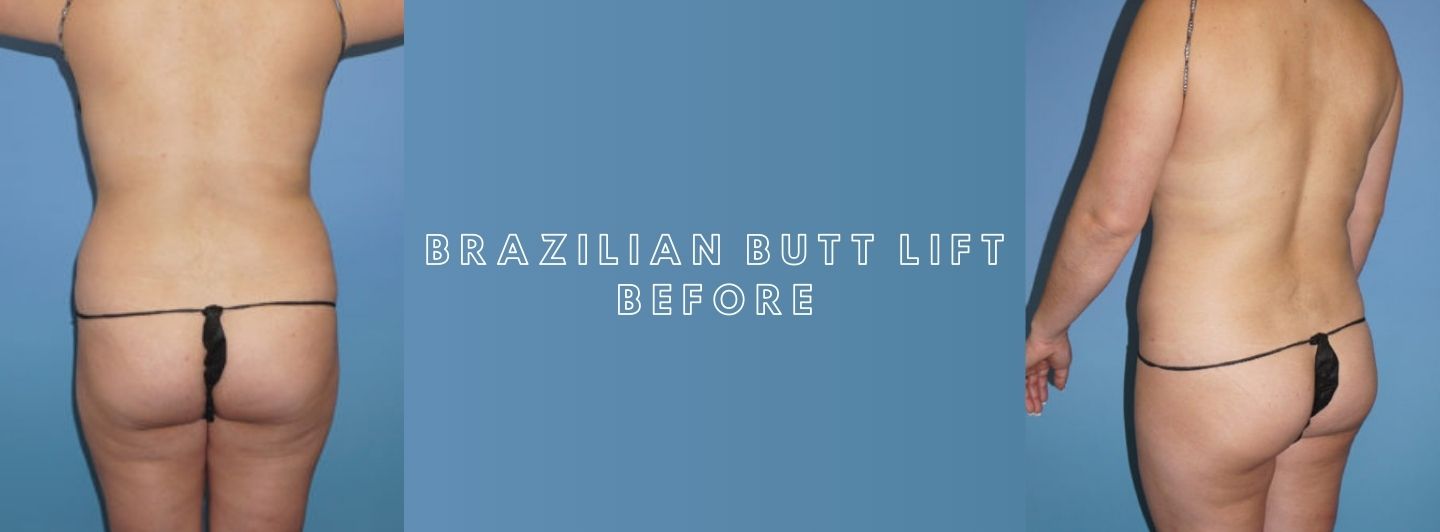 Case2 BRAZILIAN BUTT LIFT before