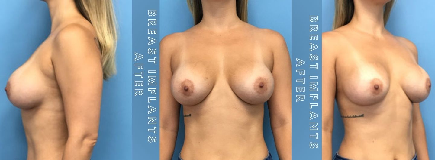 Case2 BREAST IMPLANTS AFTER