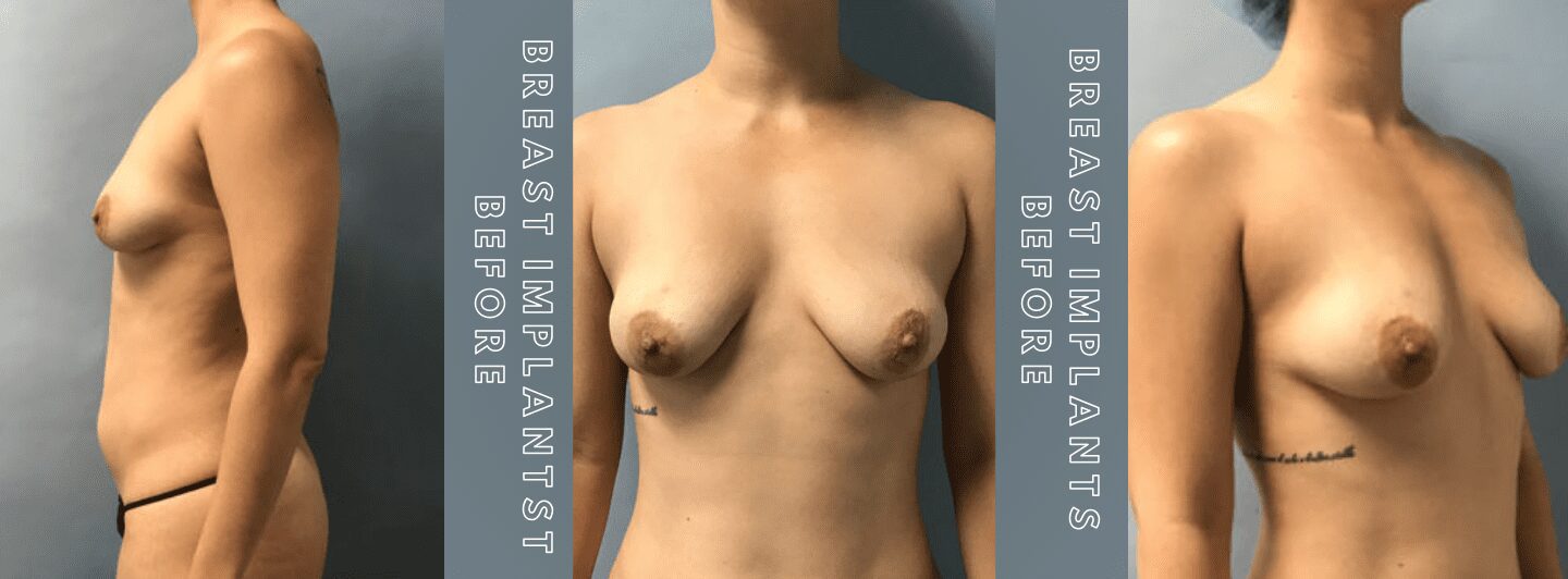 Case2 BREAST IMPLANTS BEFORE