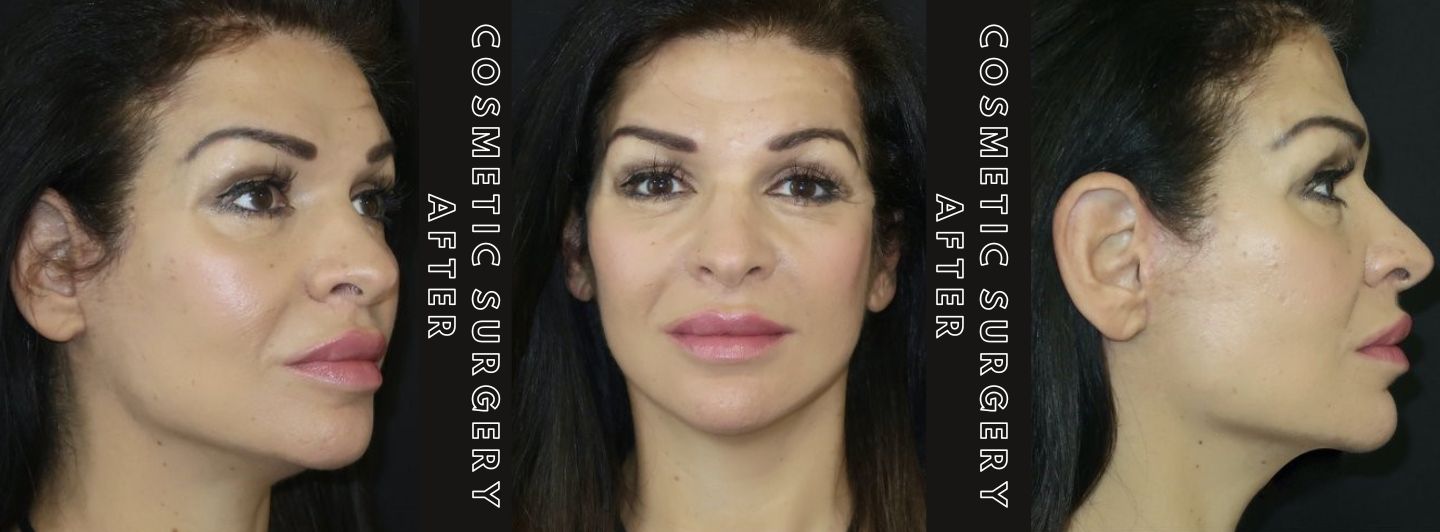 Case2 COSMETIC SURGERY AFTER