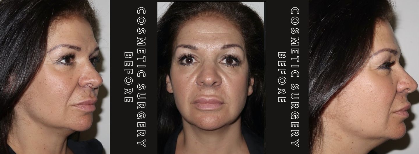 Case2 COSMETIC SURGERY BEFORE