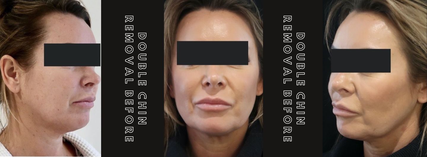 Case2 Double Chin Removal BEFORE