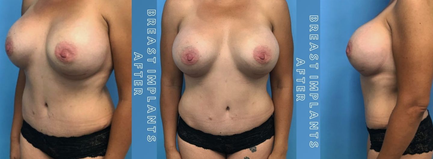 Case3 BREAST IMPLANTS AFTER