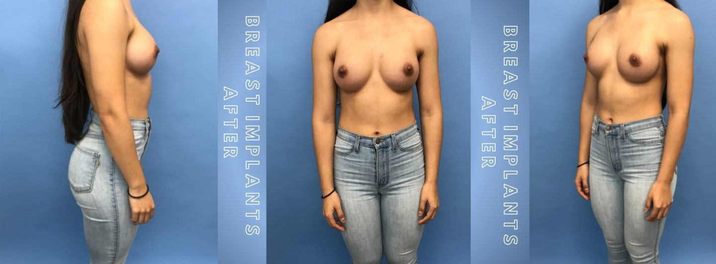 Case5 BREAST IMPLANTS AFTER
