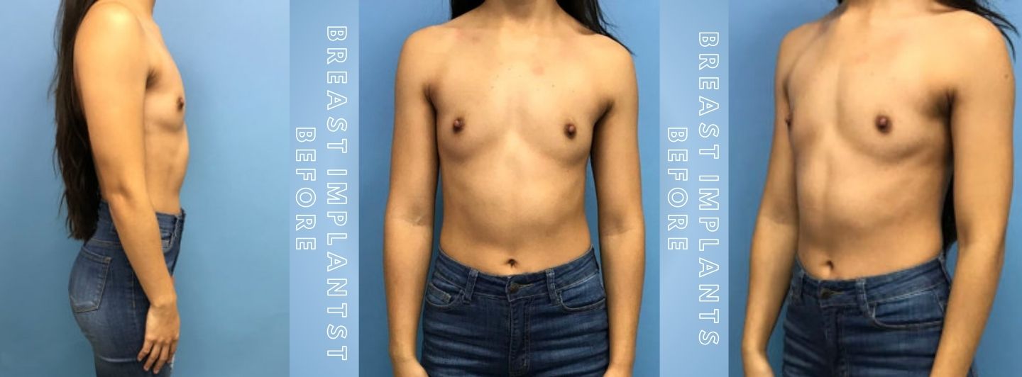 Case5 BREAST IMPLANTS BEFORE